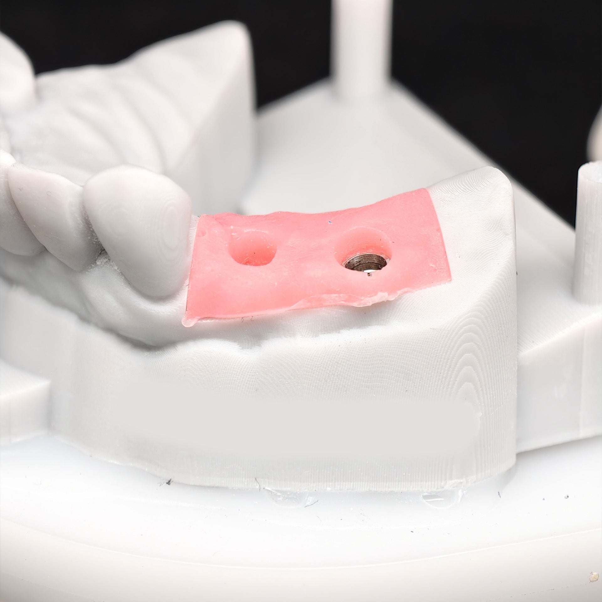 Custom Zirconia Implant Bridge