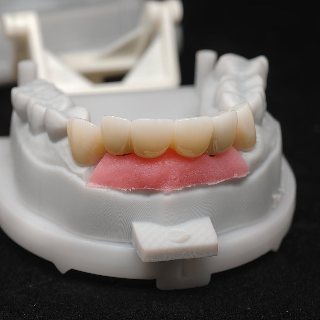 Custom Zirconia Implant Bridge