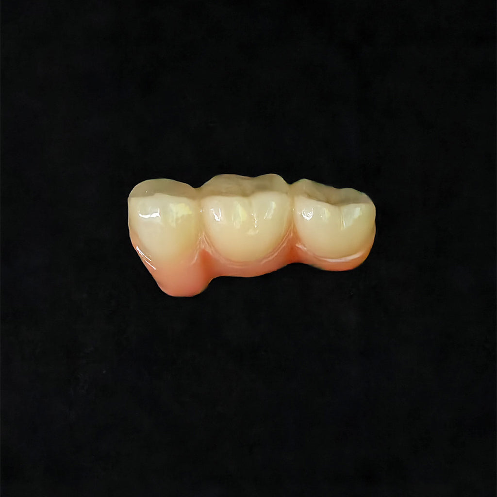 Custom Zirconia Implant Bridge
