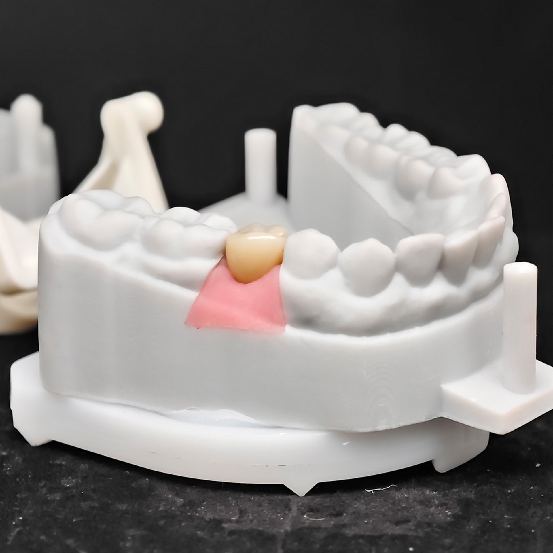 Custom Zirconia Implant Crown