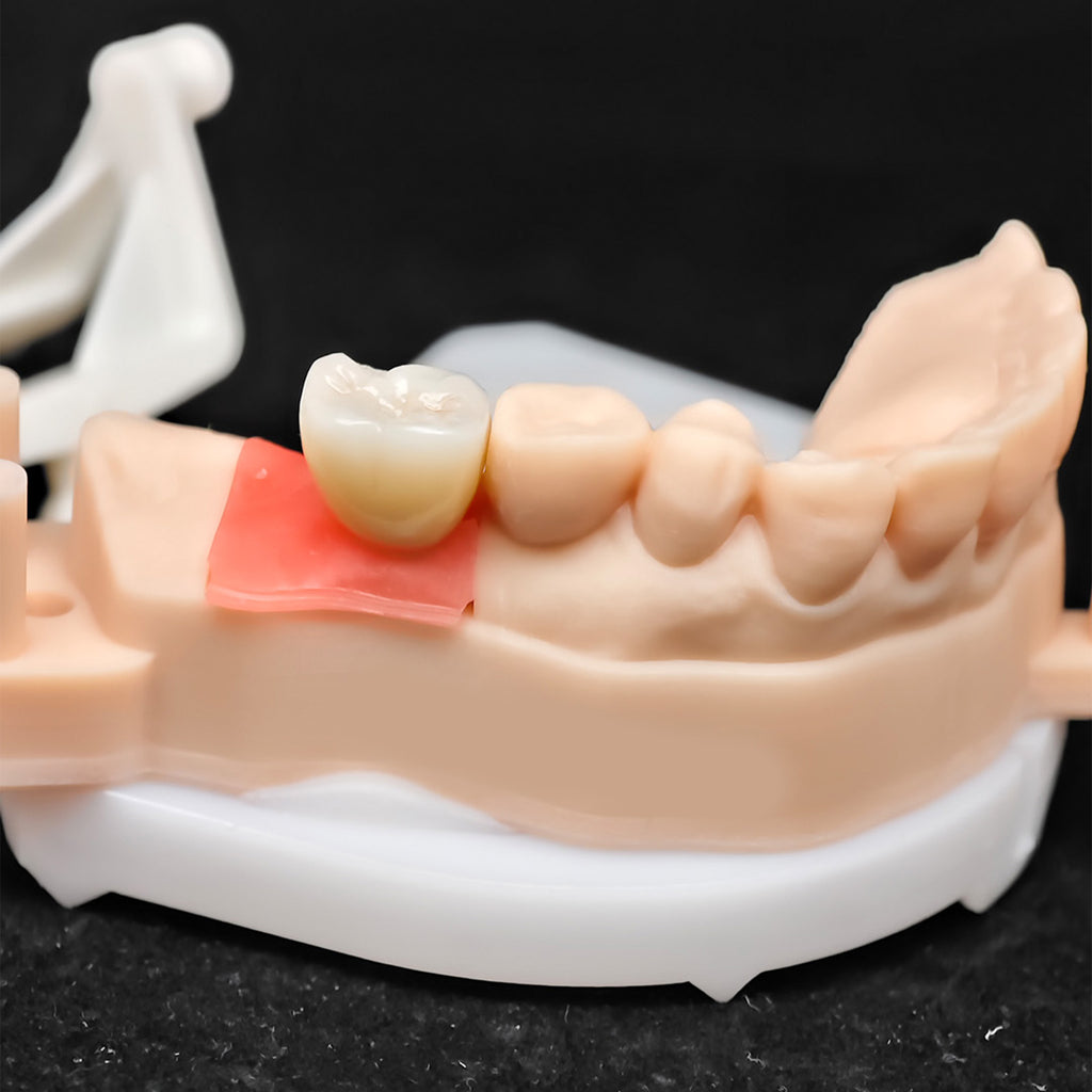 Custom Zirconia Implant Crown