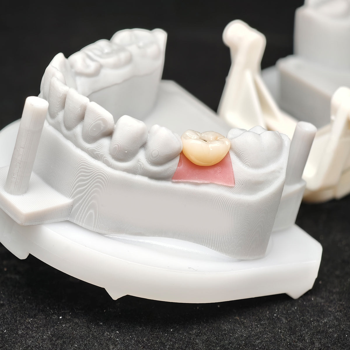Custom Zirconia Implant Crowns