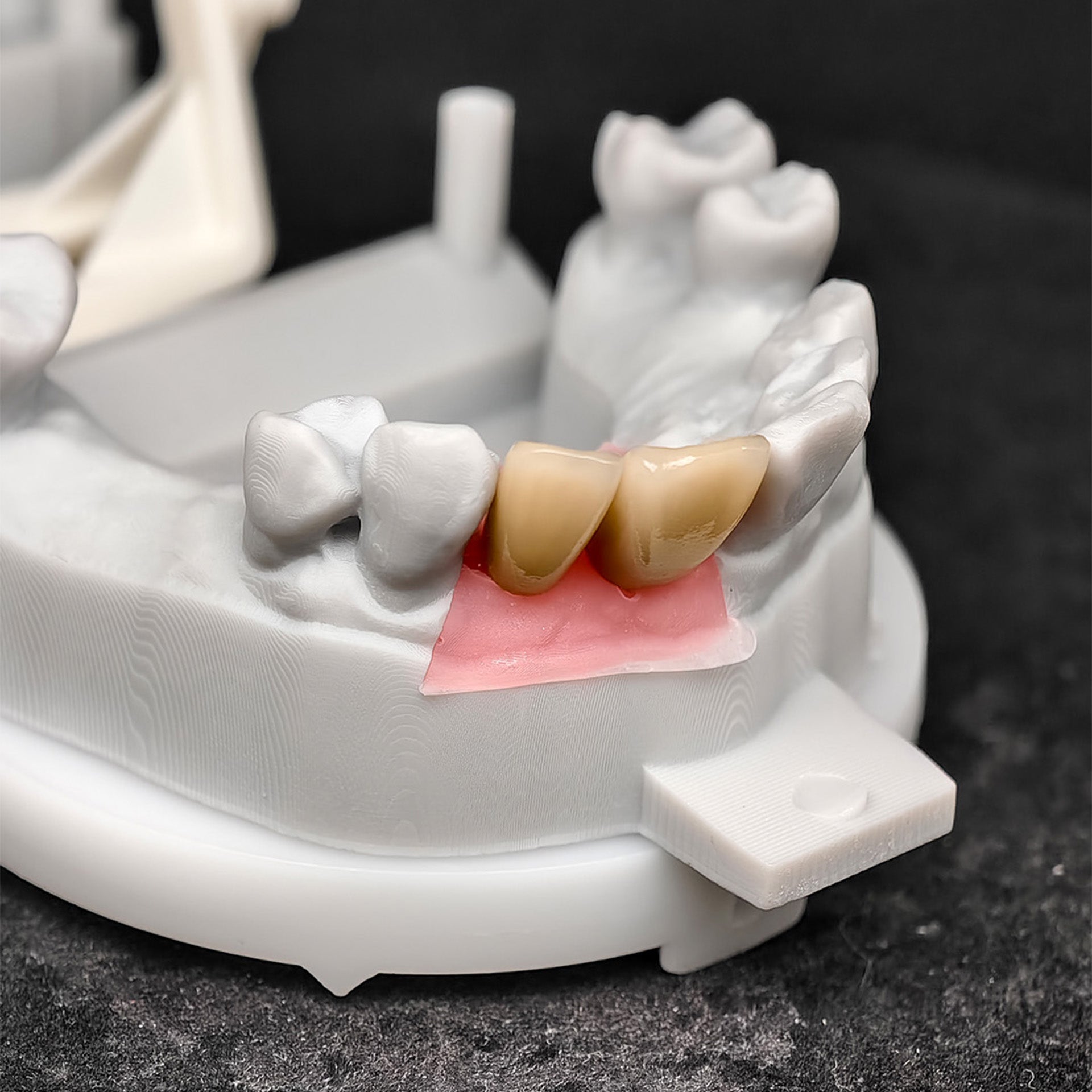 Custom Zirconia Implant Crowns