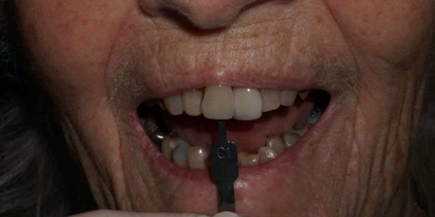 Emax With Porcelain Powder High Aesthetics