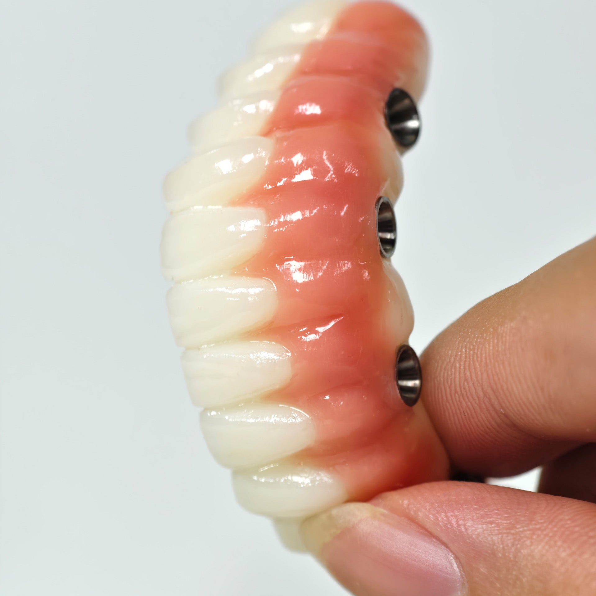 Full-Arch PMMA Bridge With Ti-Base Screw Retained
