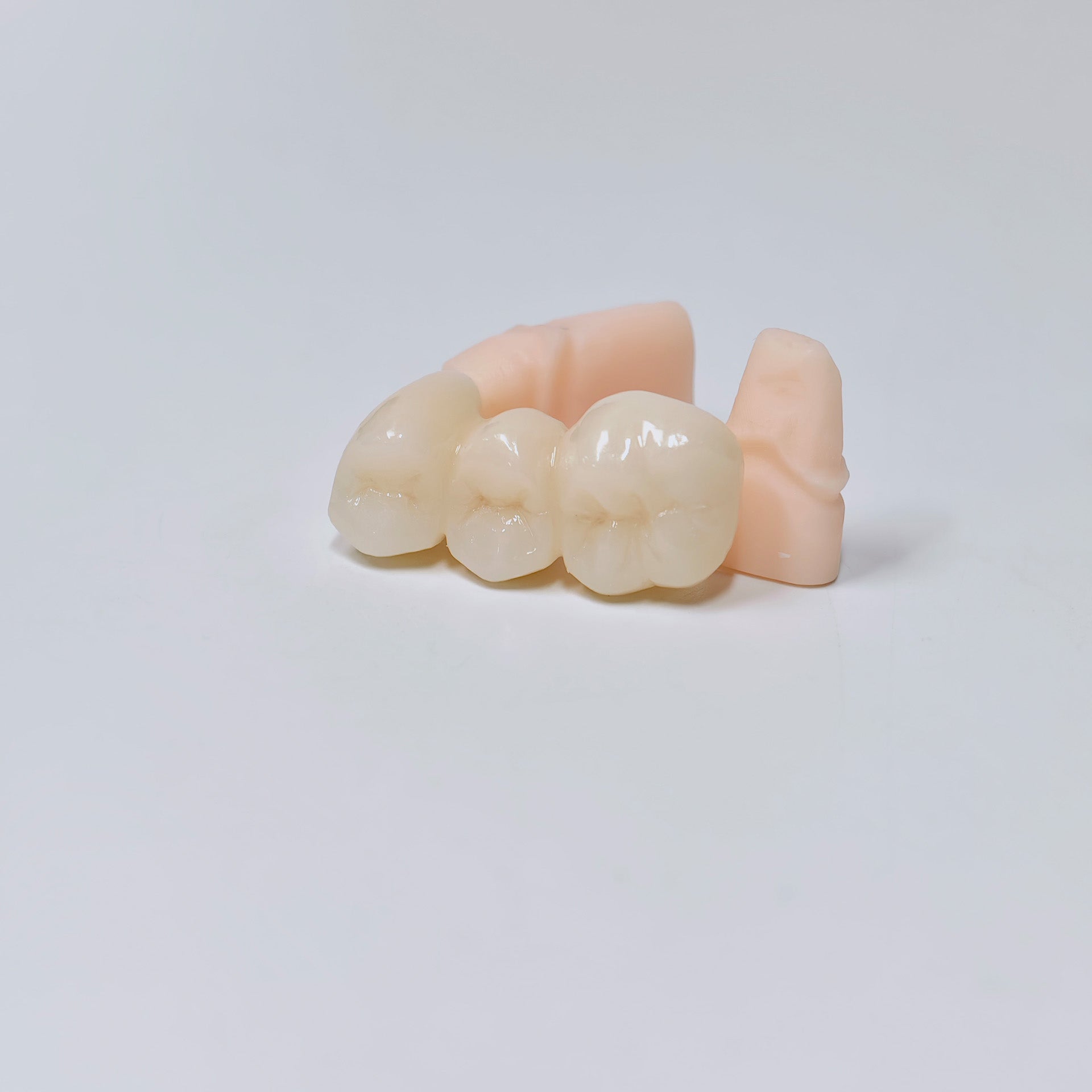 High - Strength Zirconia Bridge