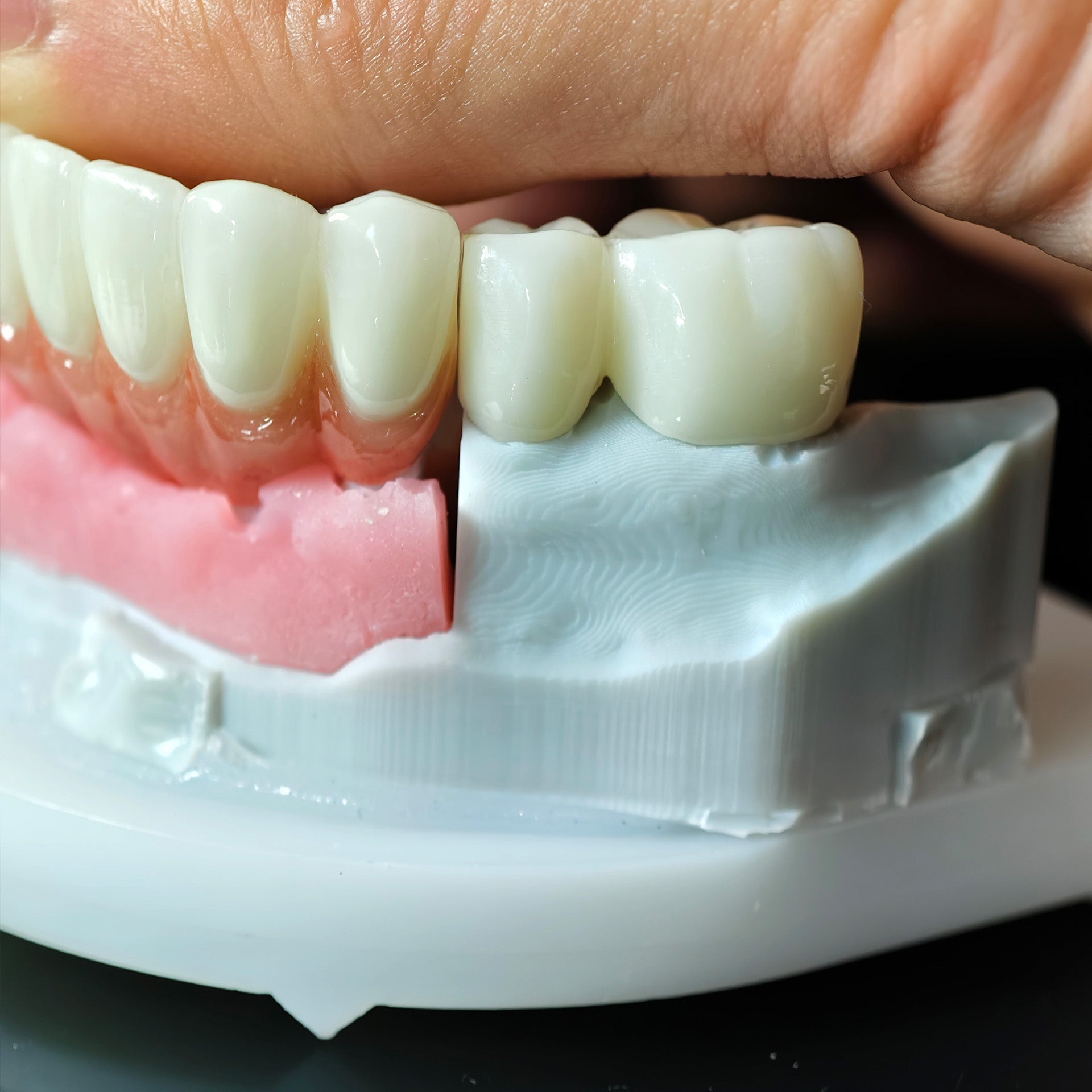 High - Strength Zirconia Crowns And Bridge