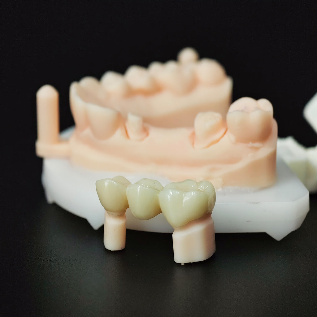 High - Strength Zirconia Bridge