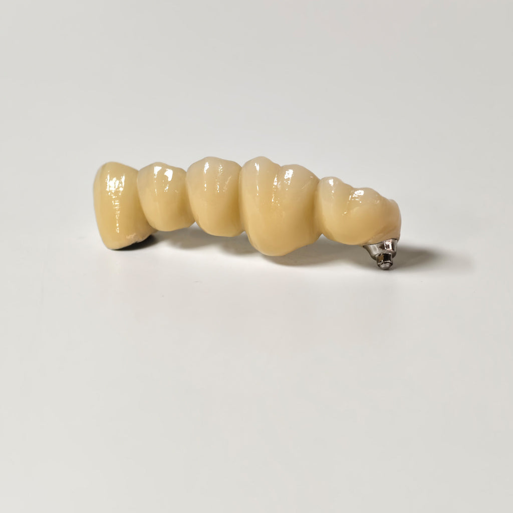 Implant-Supported PFM Single Bridge