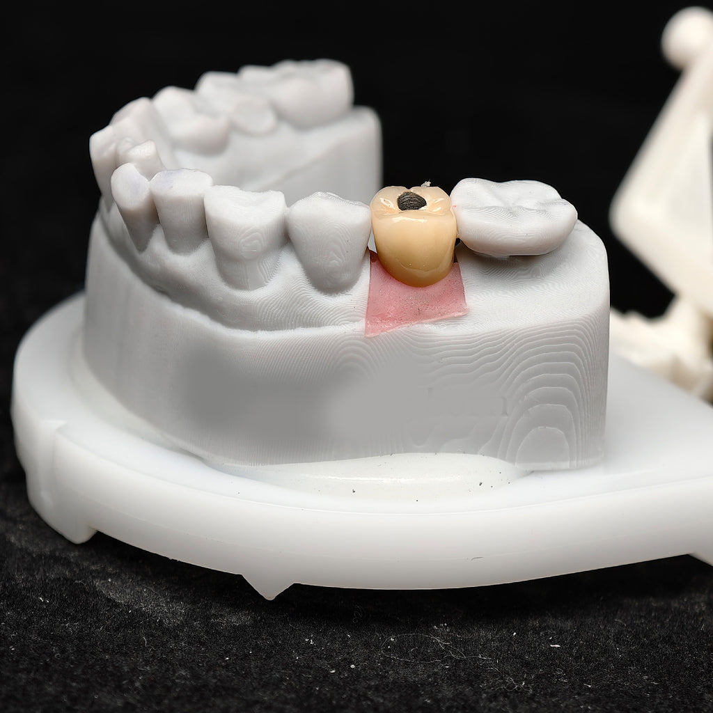 Implant-Supported PFM Single Crown
