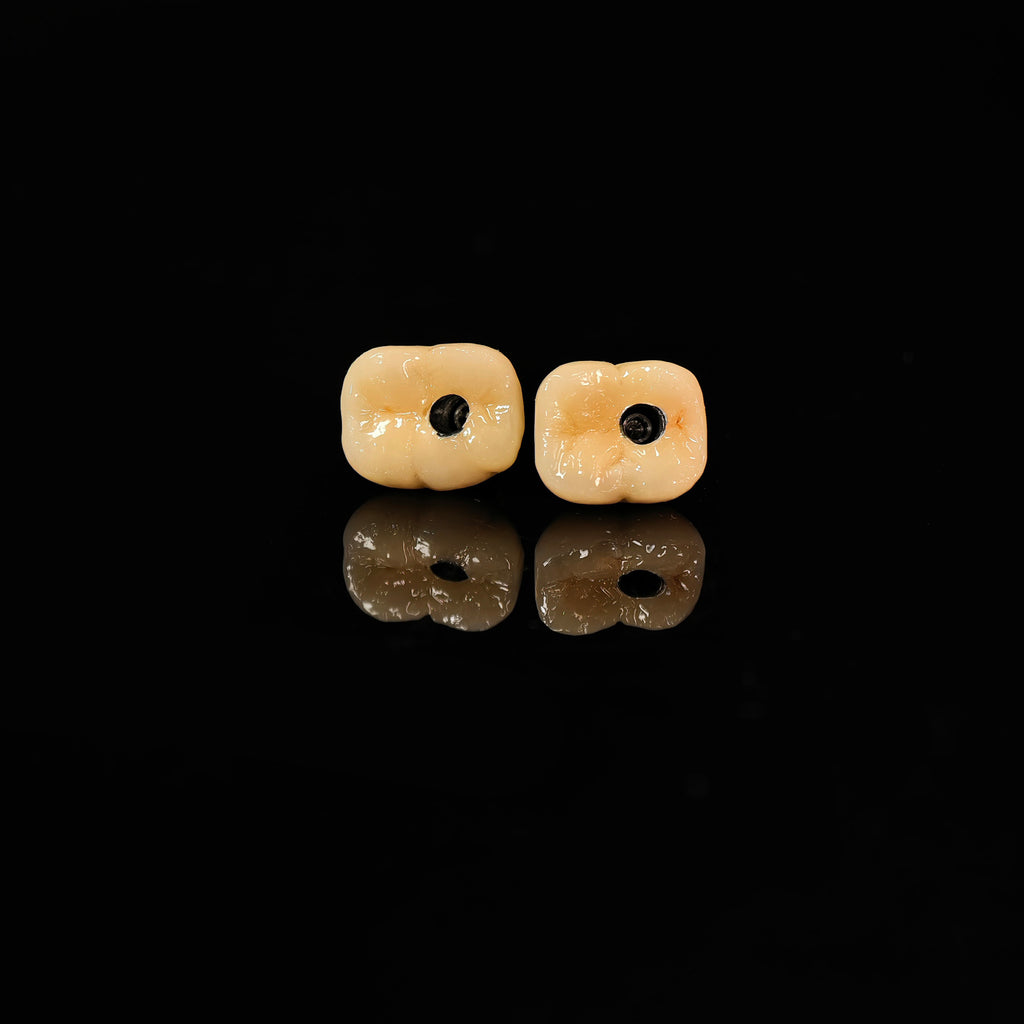 Implant-Supported PFM Single Crowns