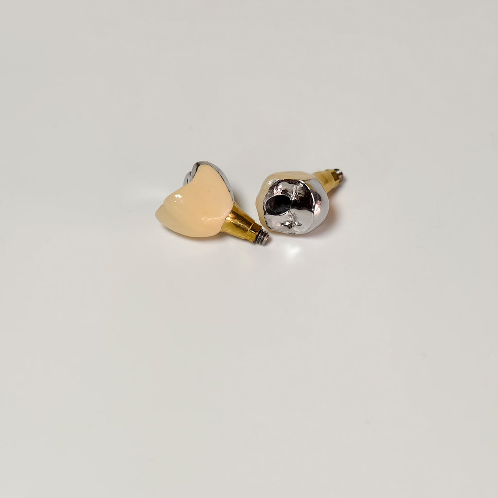 Implant-Supported PFM Single Crowns With Metal