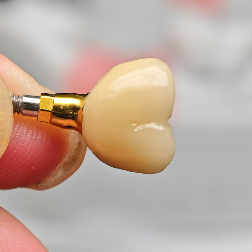 Implant-Supported PFM Single Crown With Metal