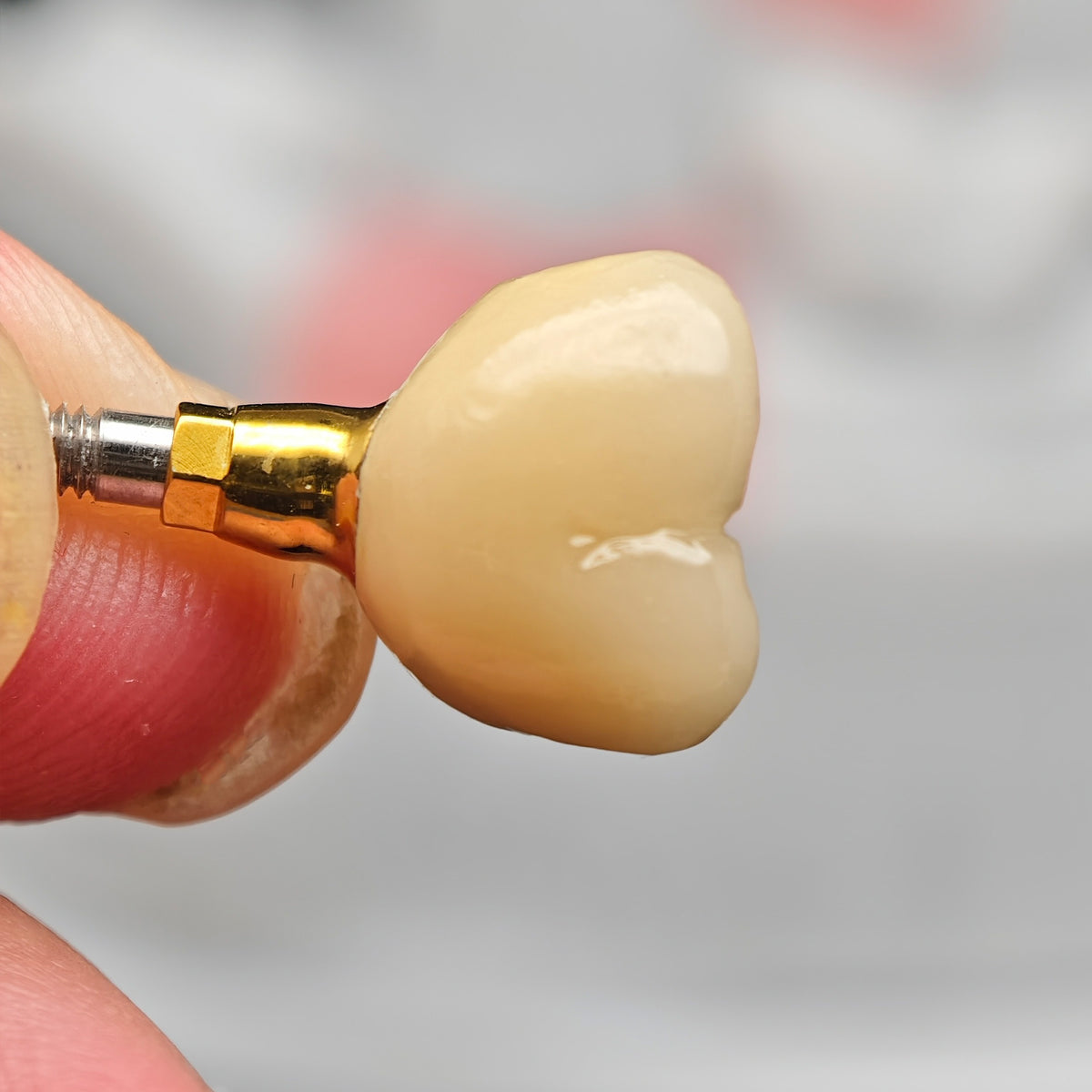Implant-Supported PFM Single Crown With Metal