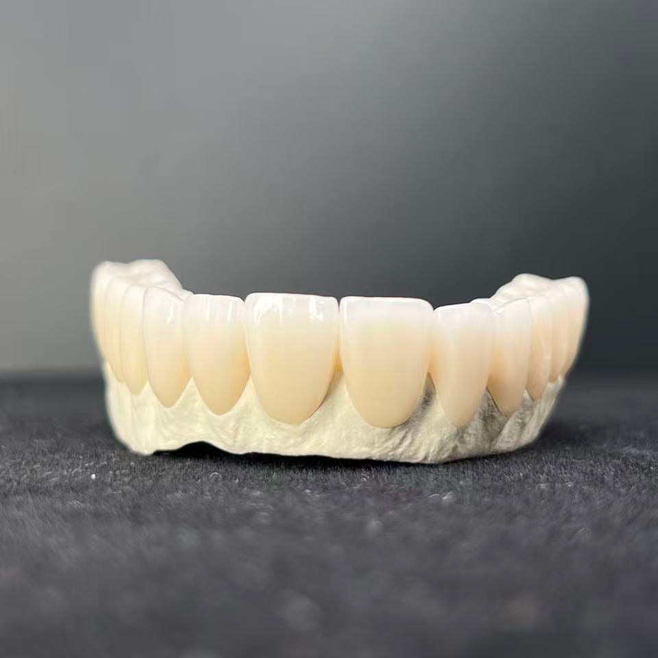 Malo Bridge Implant Restorations