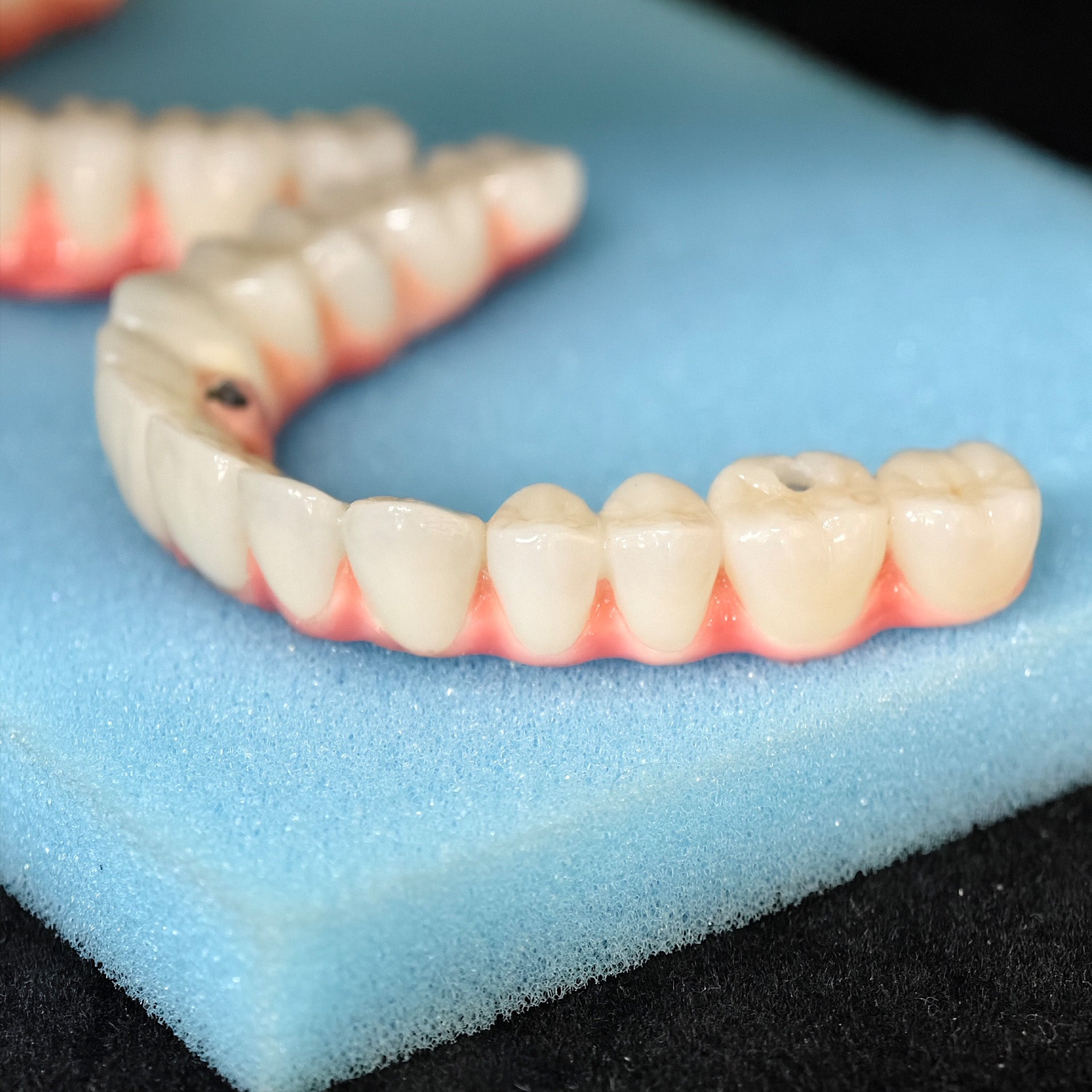 Malo Bridge Implant Restorations