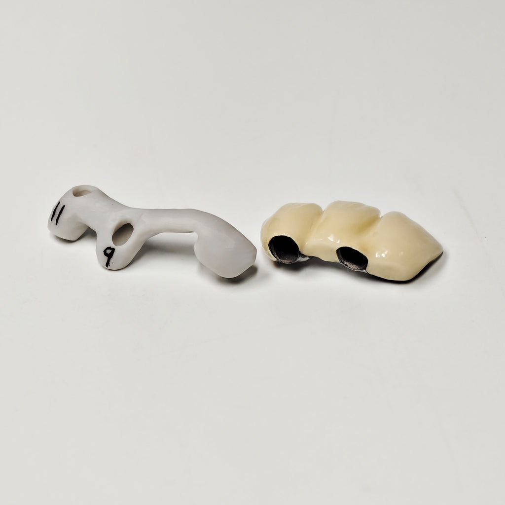 PFM Bridge With Screw-Retained And Implant Seating Guide