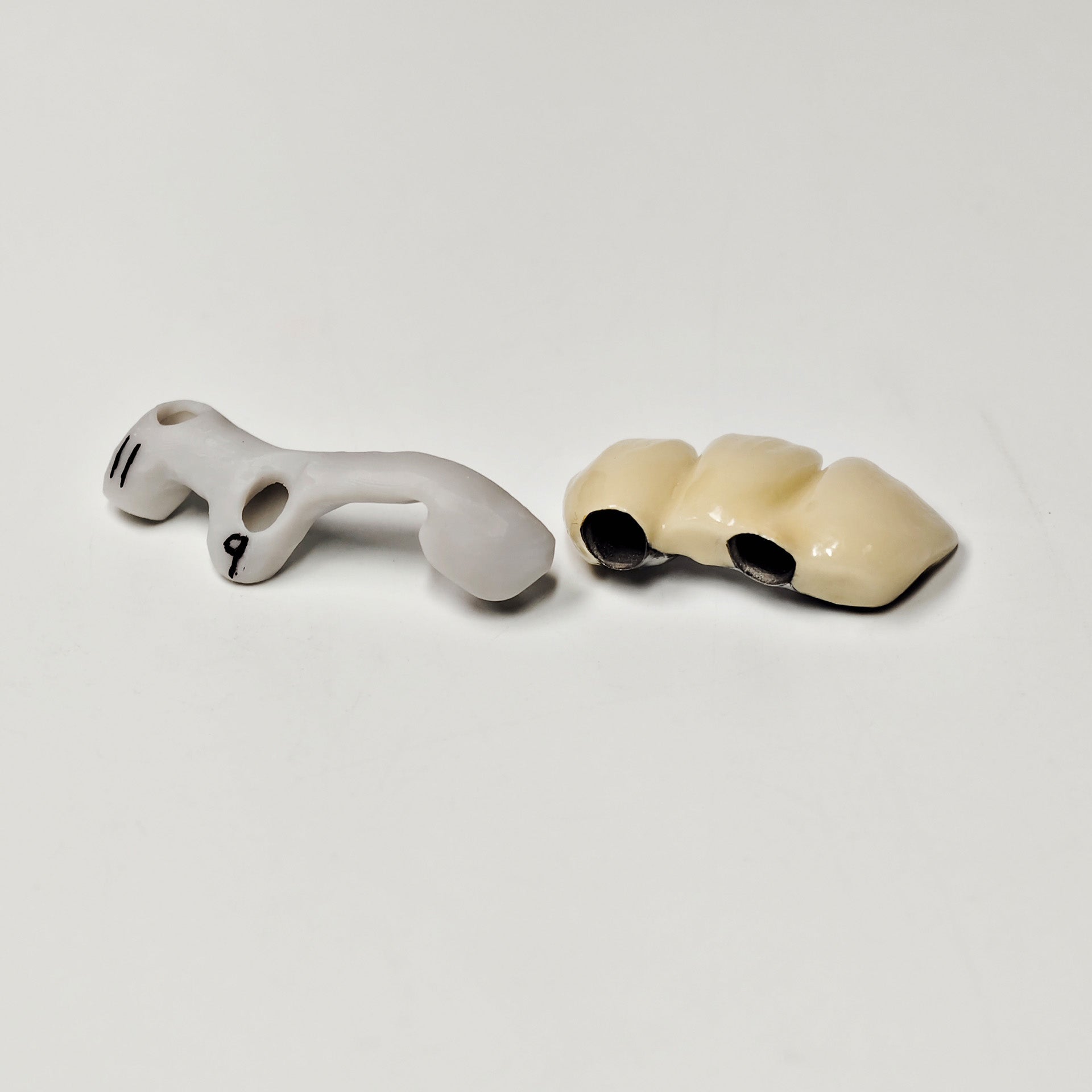 PFM Bridge With Screw-Retained And Implant Seating Guide