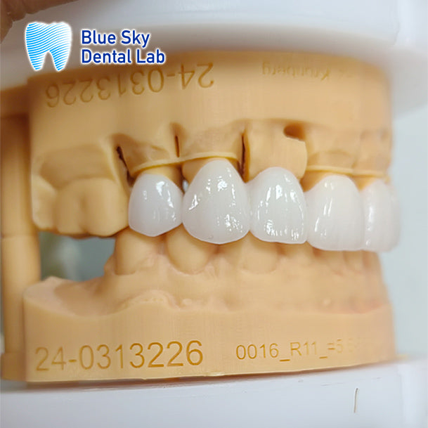 PFZ Porcelain Fused Zirconia Aidite Zirconia Affordable Dental Lab