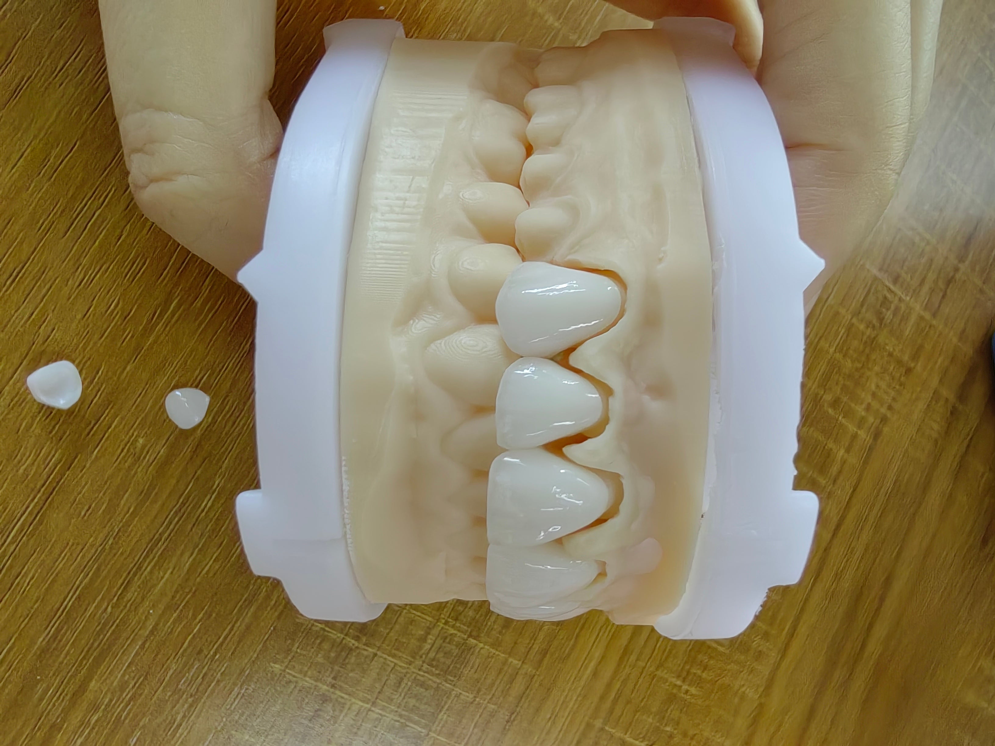 PFZ Zirconia Crowns And Bridge