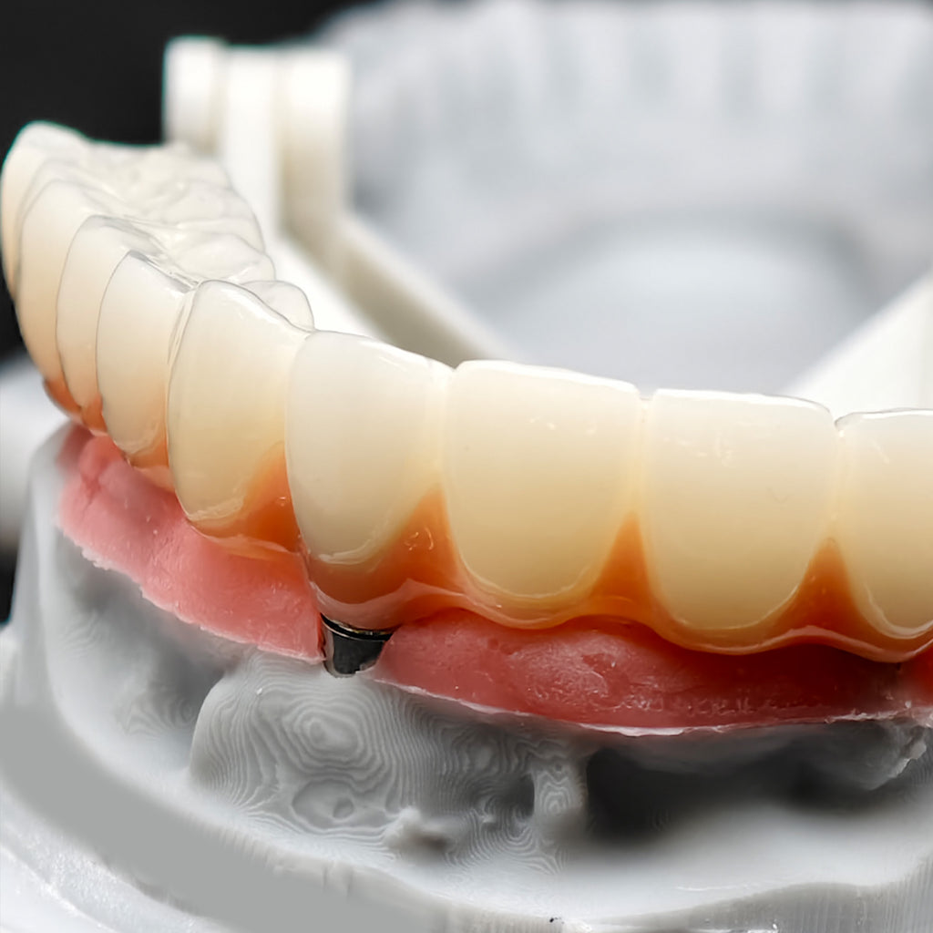 PMMA Bridge With Ti-Base Screw Retained Trying For Full Arch Restoration