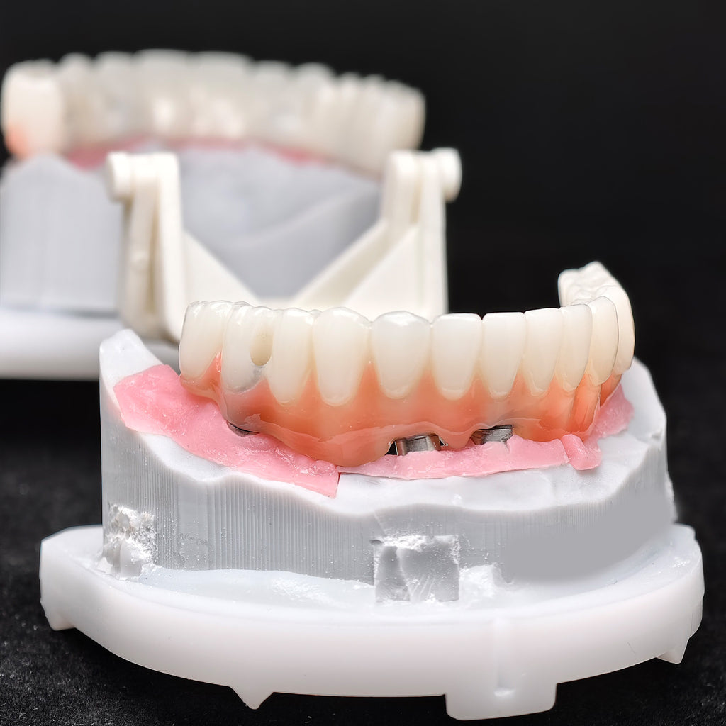 PMMA Bridge With Ti-Base Screw Retained Trying For Full Arch Restoration