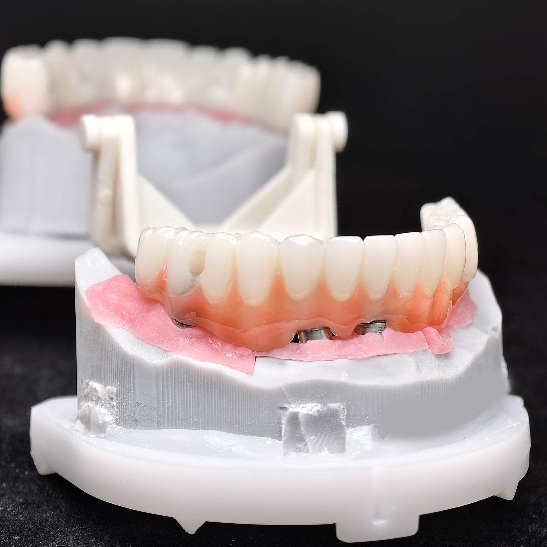 PMMA Bridge With Ti-Base Screw Retained Trying For Full Arch Restoration