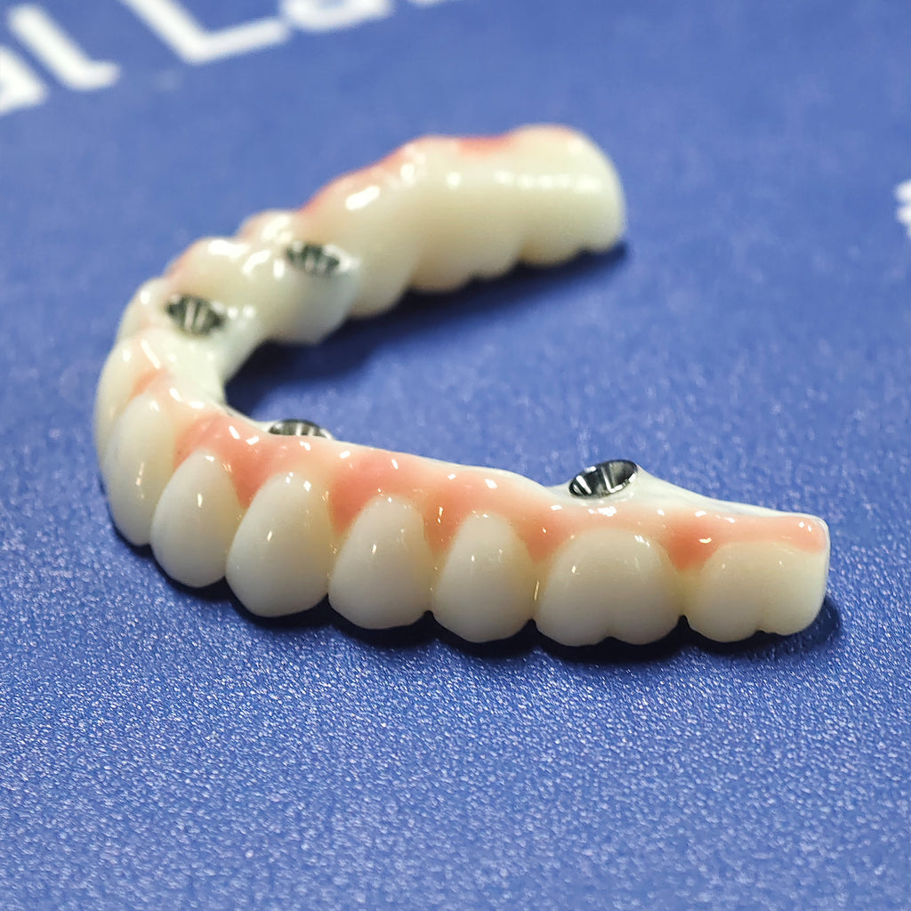 PMMA Bridge With Ti-Base Screw Retained Trying For Full Arch Restoration