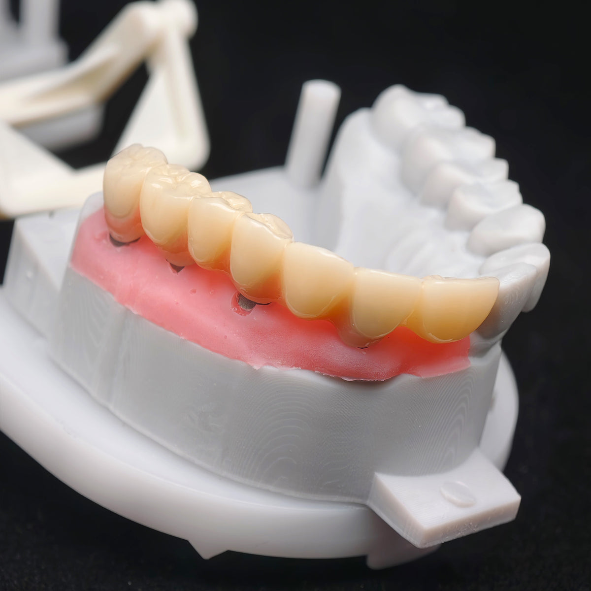 PMMA Bridge With Custom Abutment And Implant Seating Guide