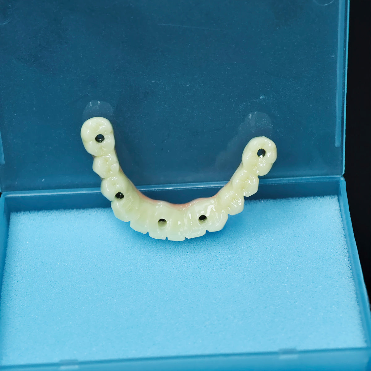 PMMA Bridge With Screw Retained