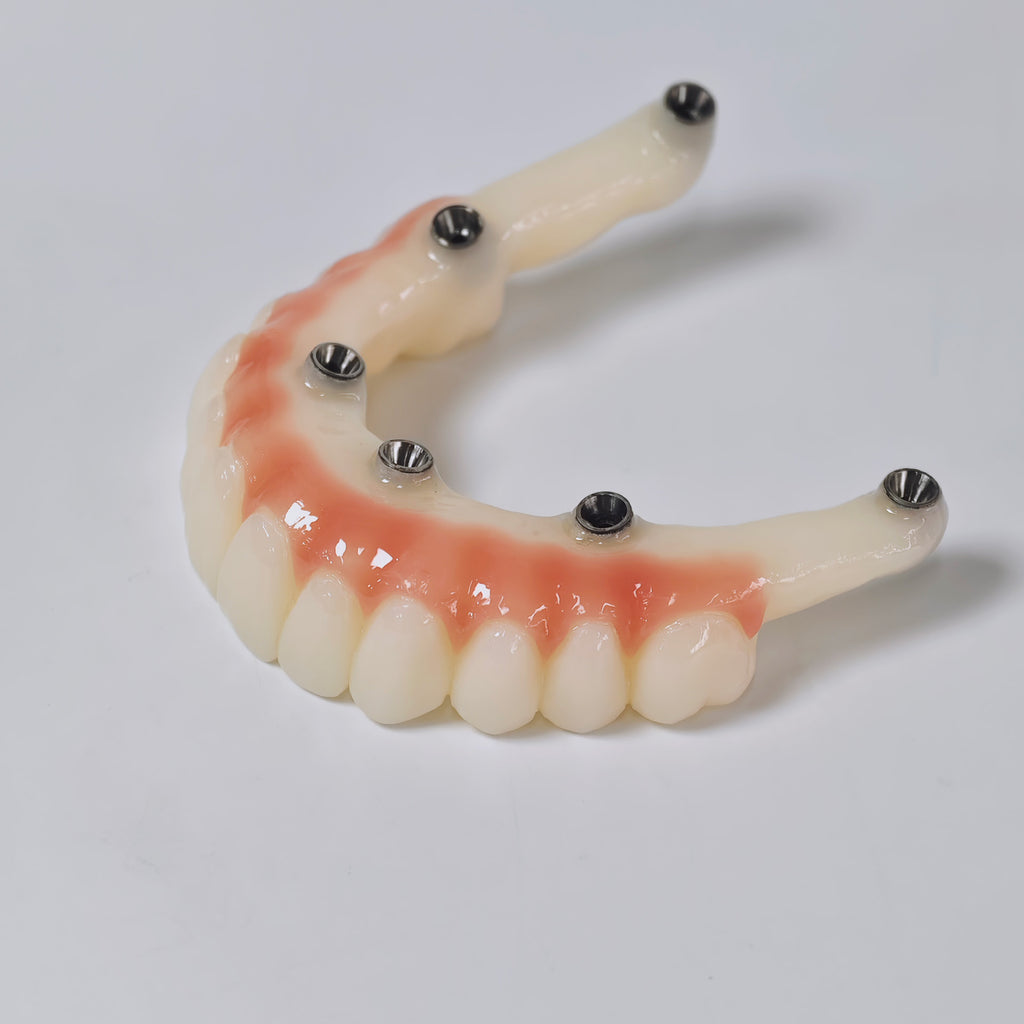PMMA Bridge With Screw Retained
