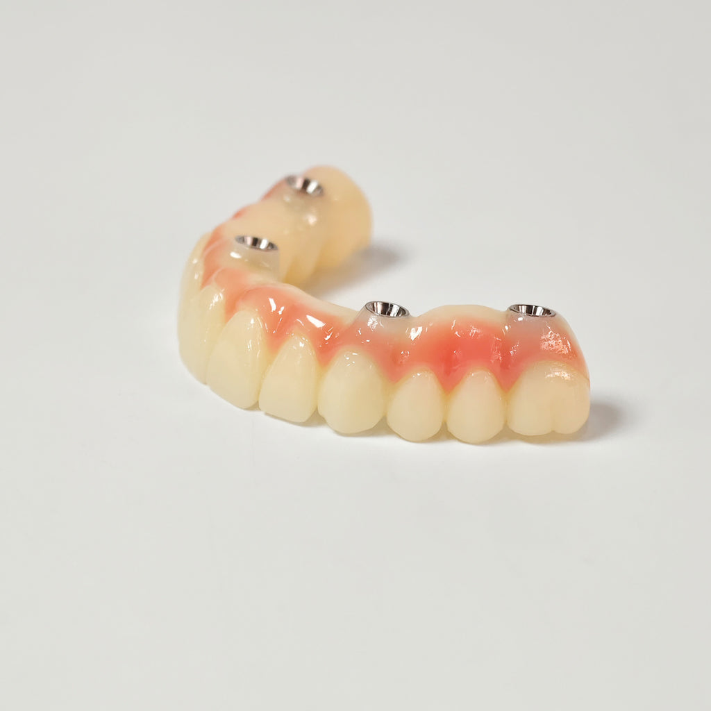 PMMA Bridge With Screw Retained