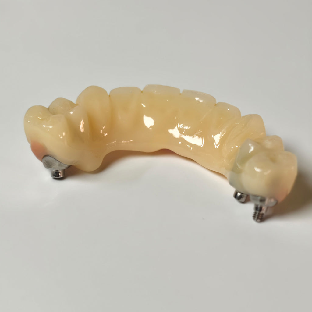 PMMA Bridge With Screw Retained