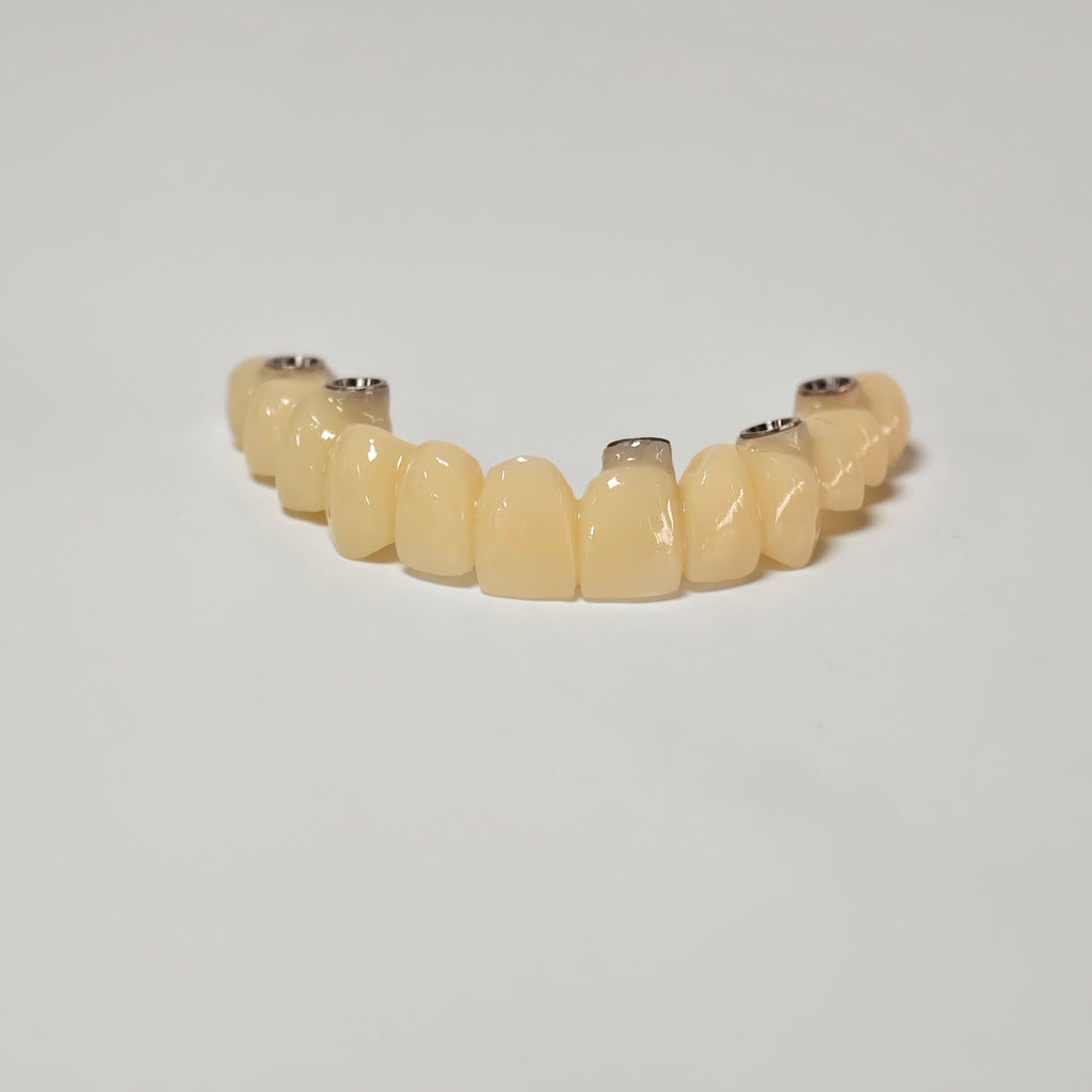 PMMA Bridge With Screw Retained