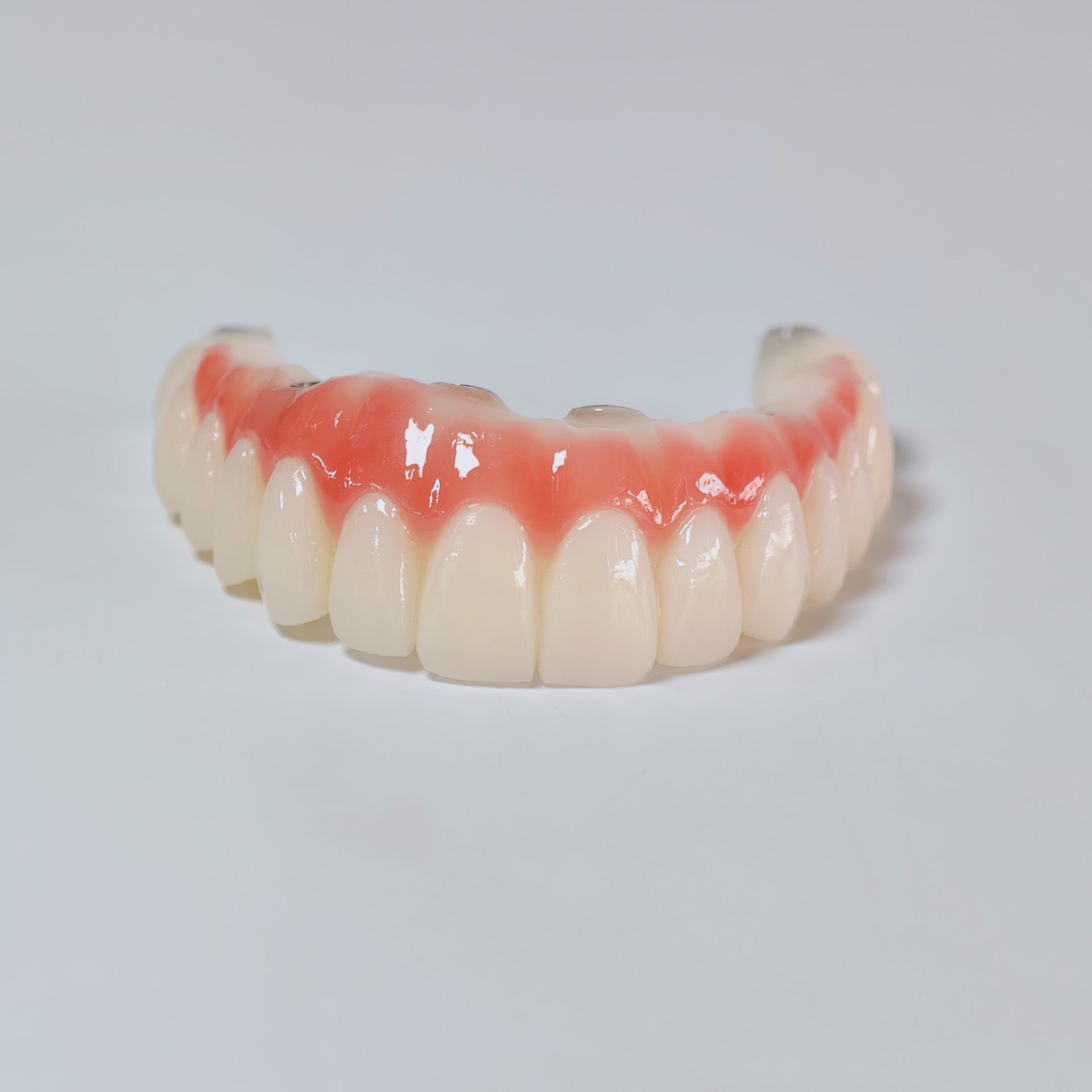 PMMA Bridge With Screw Retained