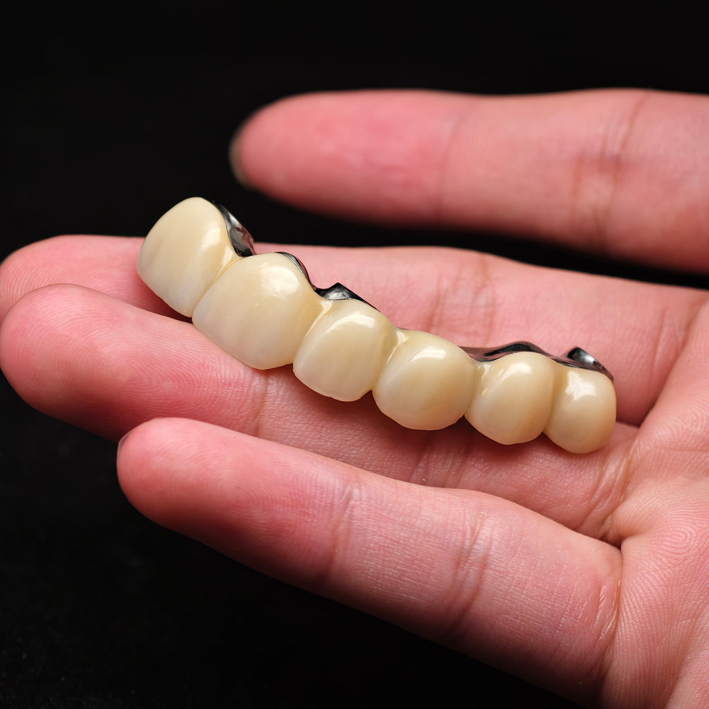 Ti-Bar Pure Titanium Metal Frame With Zirconia Bridge Implant