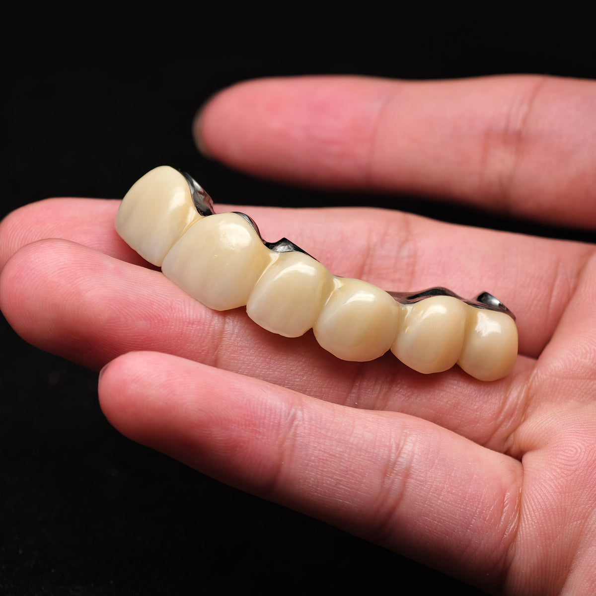 Ti-Bar Pure Titanium Metal Frame With Zirconia Bridge Implant