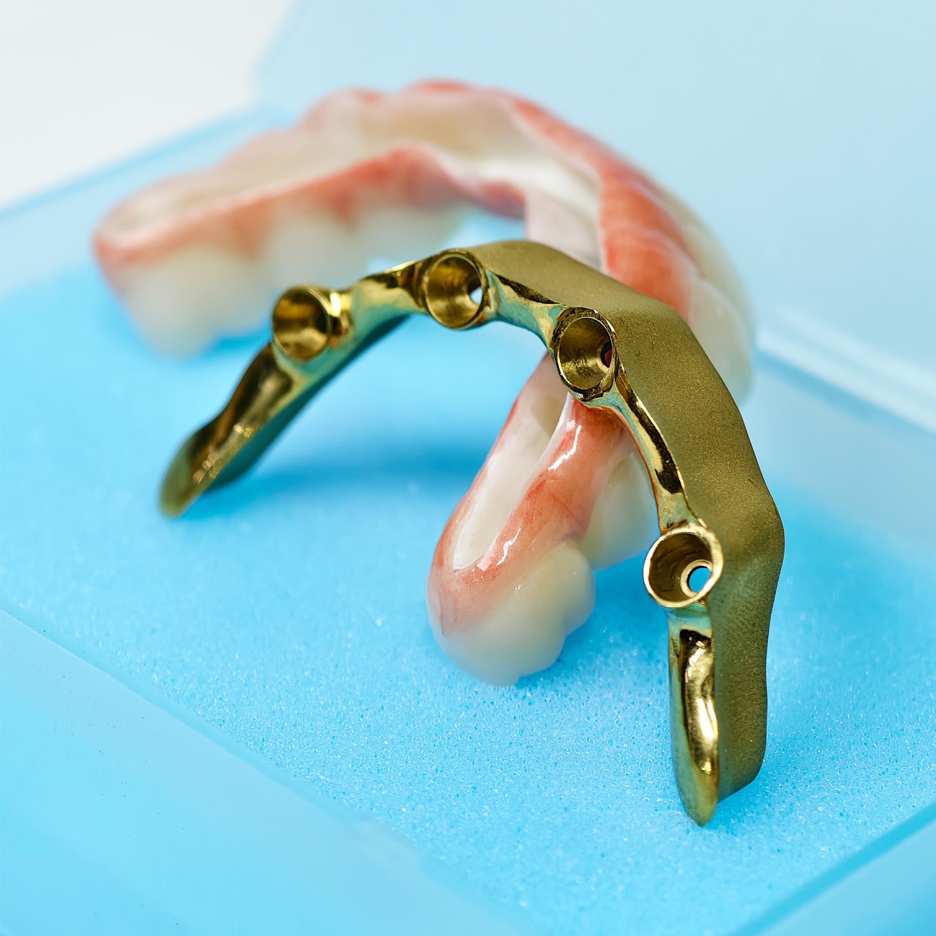 Ti-Bar Titanium Nitride Metal Frame With Zirconia Bridge For Full Arch Restoration