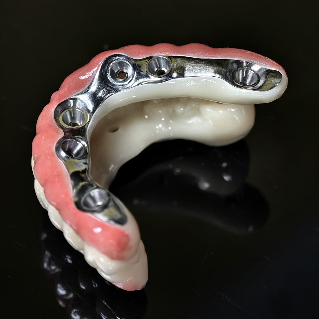 Ti-Bar Titanium Nitride Metal Frame With Zirconia Bridge For Full Arch Restoration