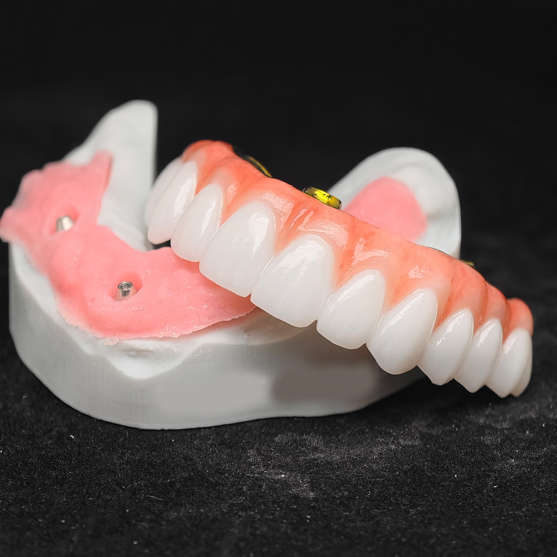Ti-Bar Titanium Nitride Metal Frame With Zirconia Bridge For Full Arch Restoration