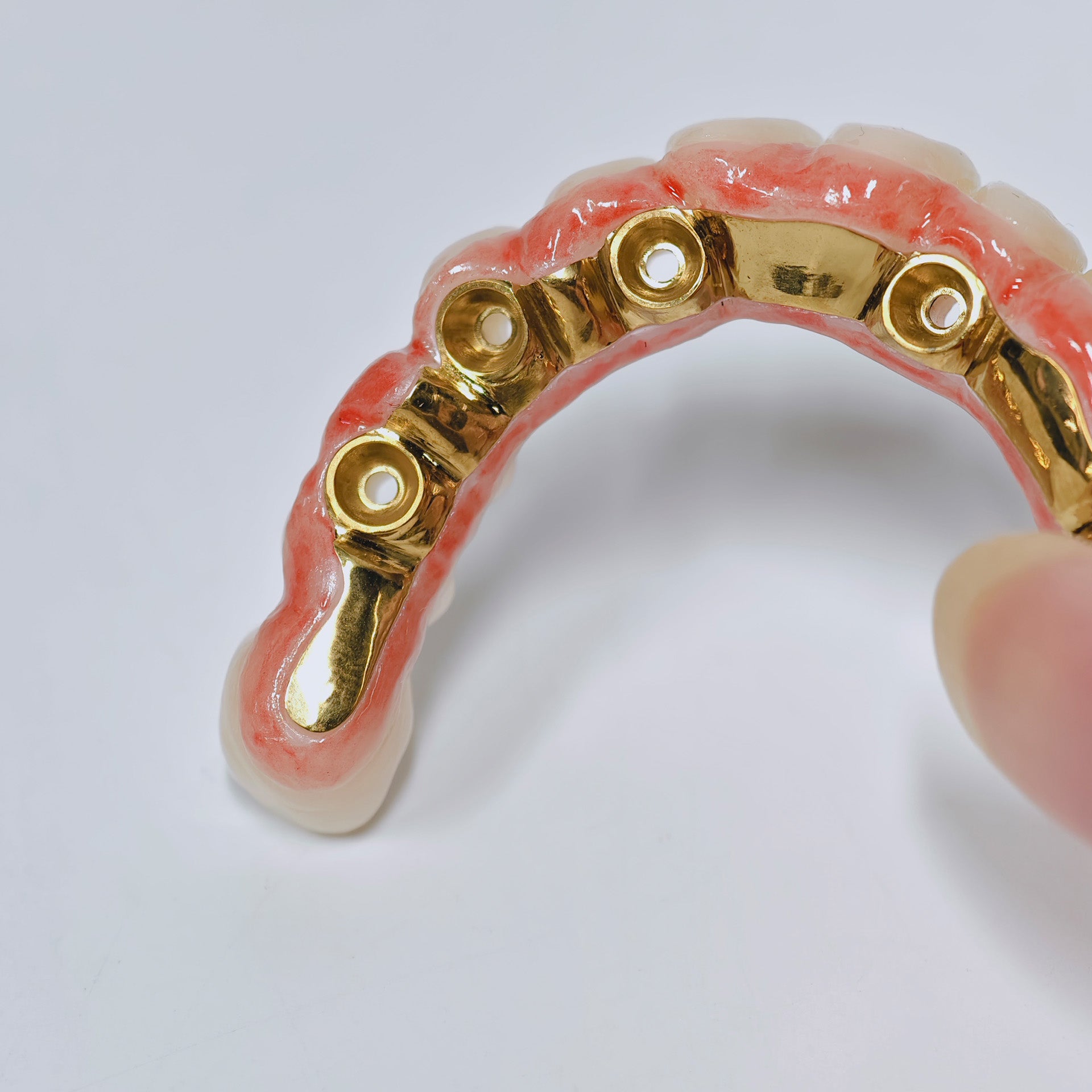 Ti-Bar Titanium Nitride Metal Frame With Zirconia Bridge For Full Arch Restoration