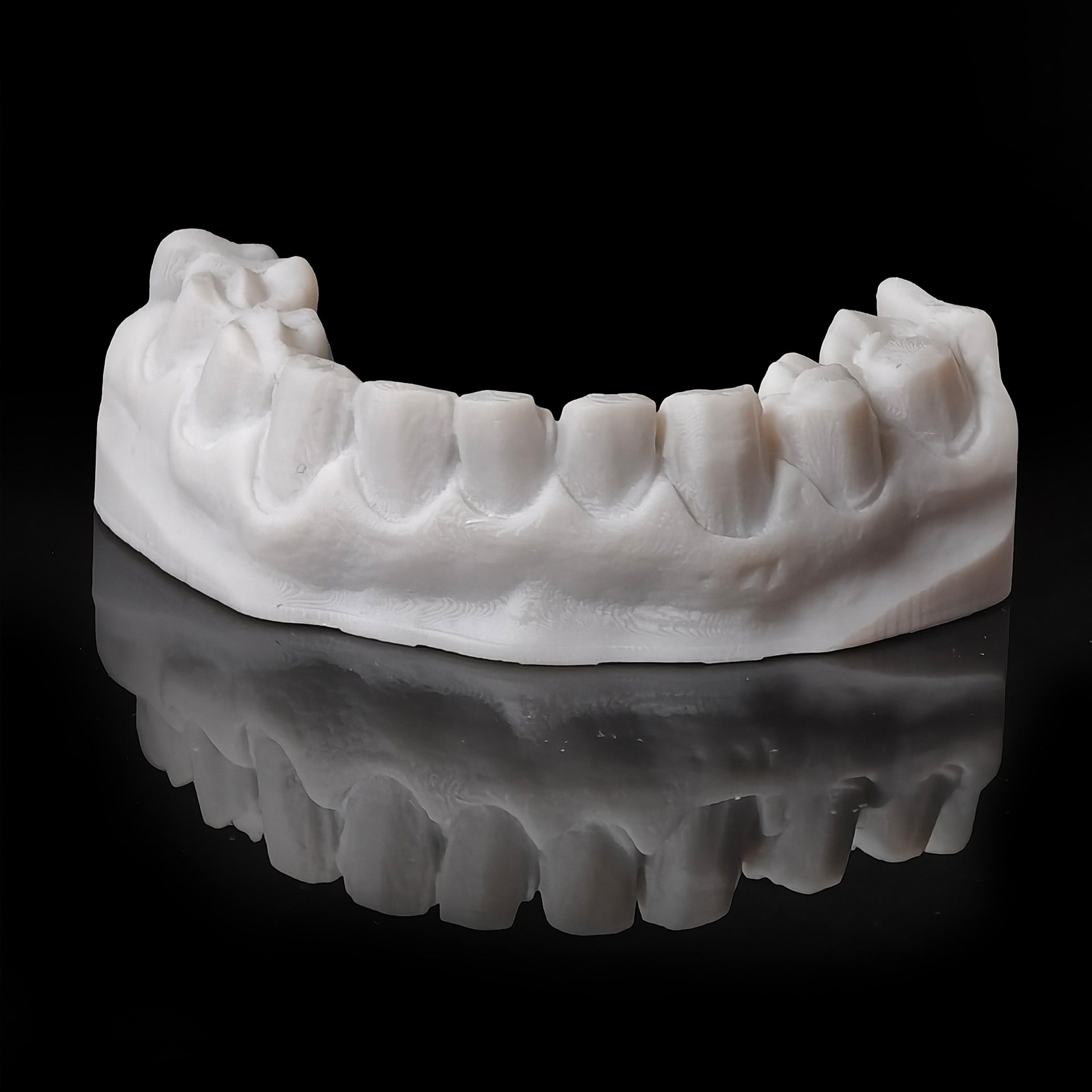 Ultra-Thin Emax Veneer. High Transparency/Translucent, Natural Shade