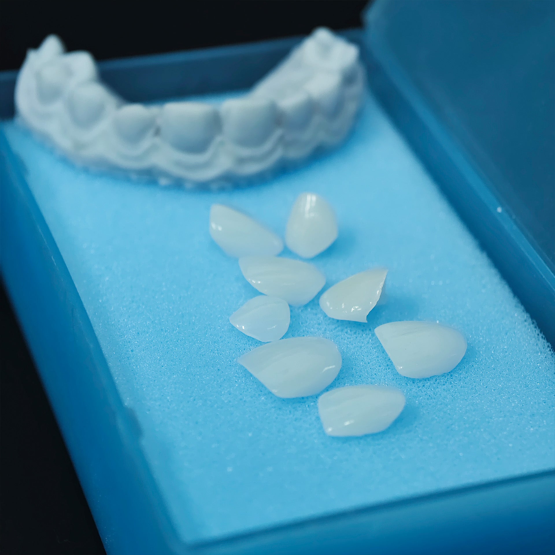 Ultra-Thin Emax Veneer. High Transparency/Translucent, Natural Shade