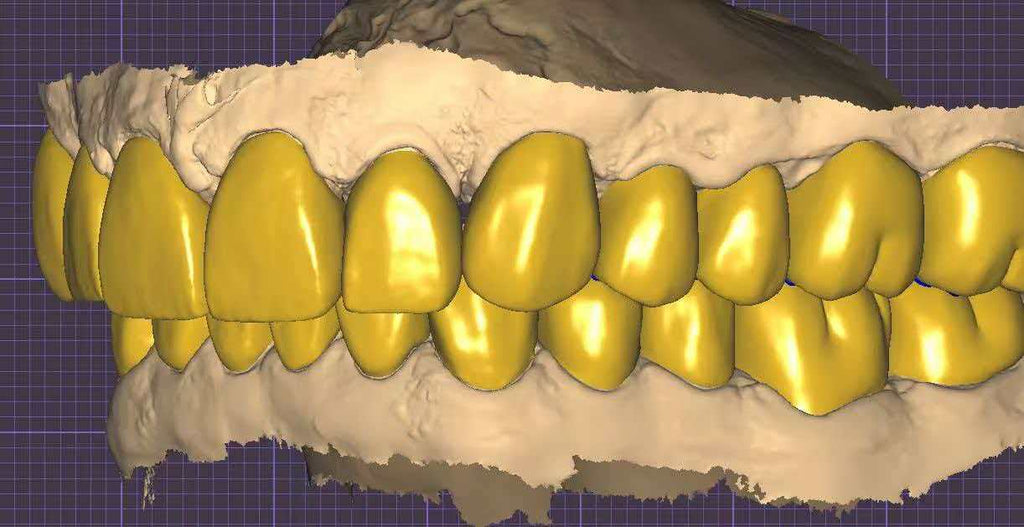 Upper And Lower Smile Design