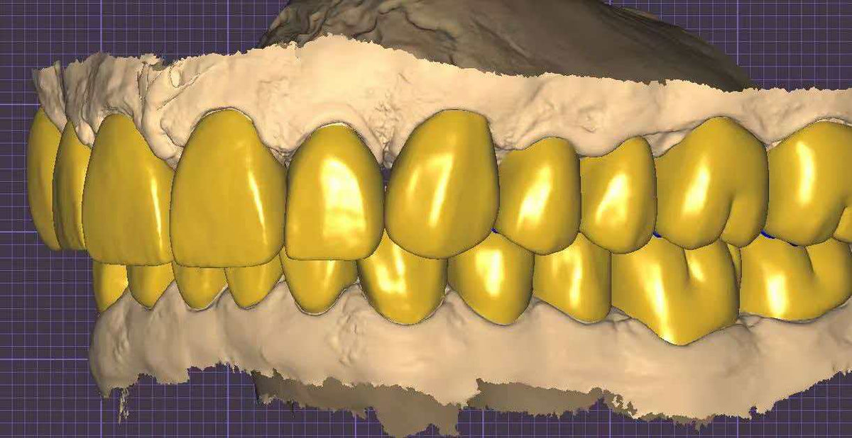 Upper And Lower Smile Design