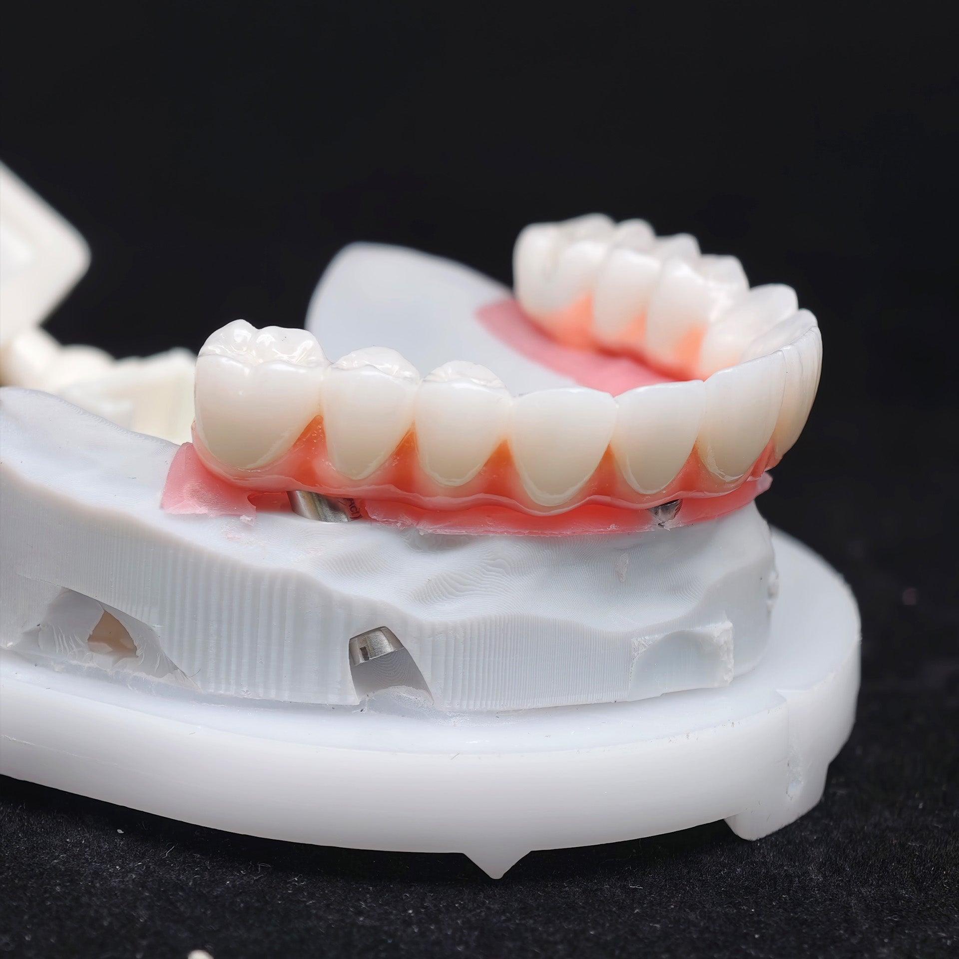 Zirconia-Enamel Hybrid Malo Bridge