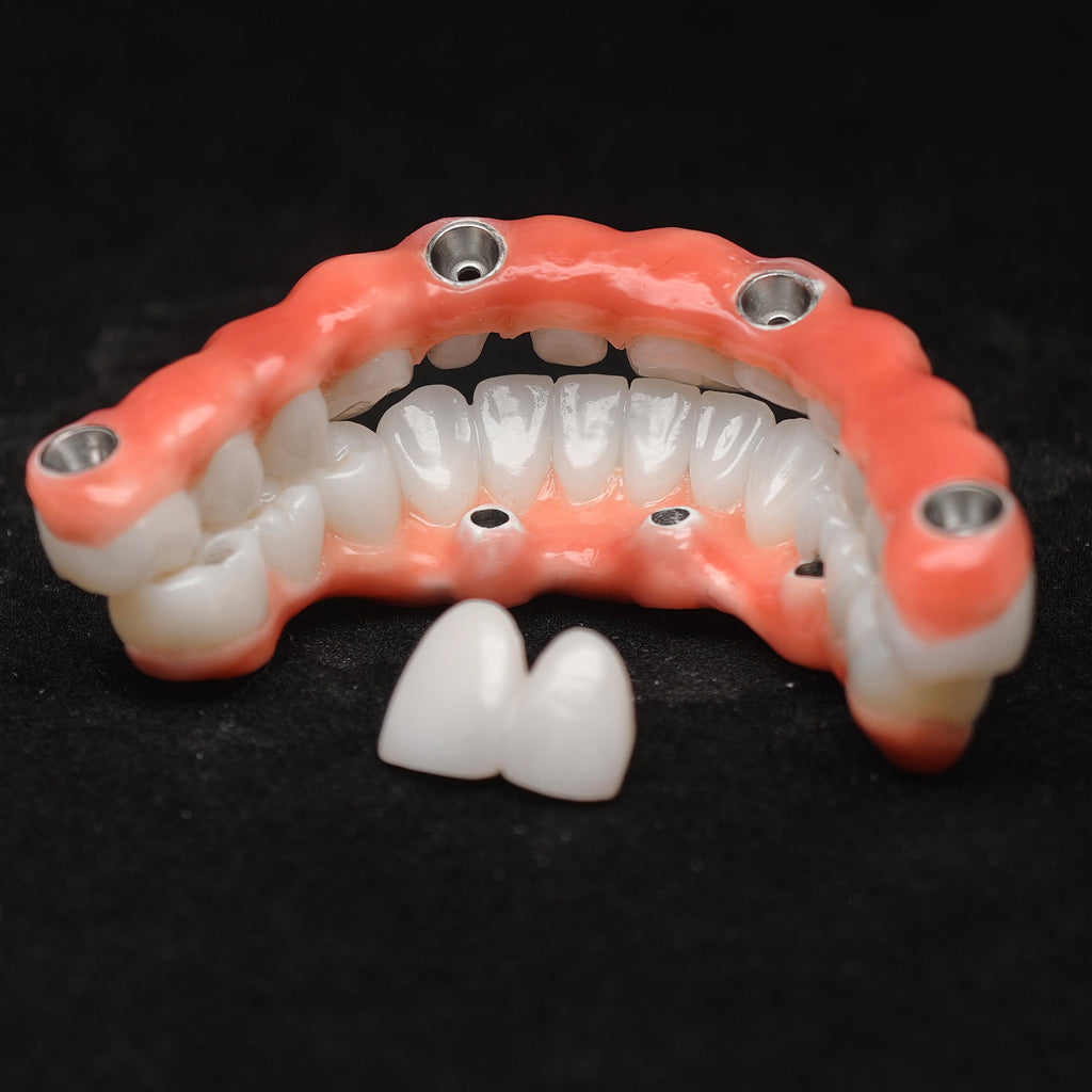 Zirconia-Enamel Hybrid Malo Bridge