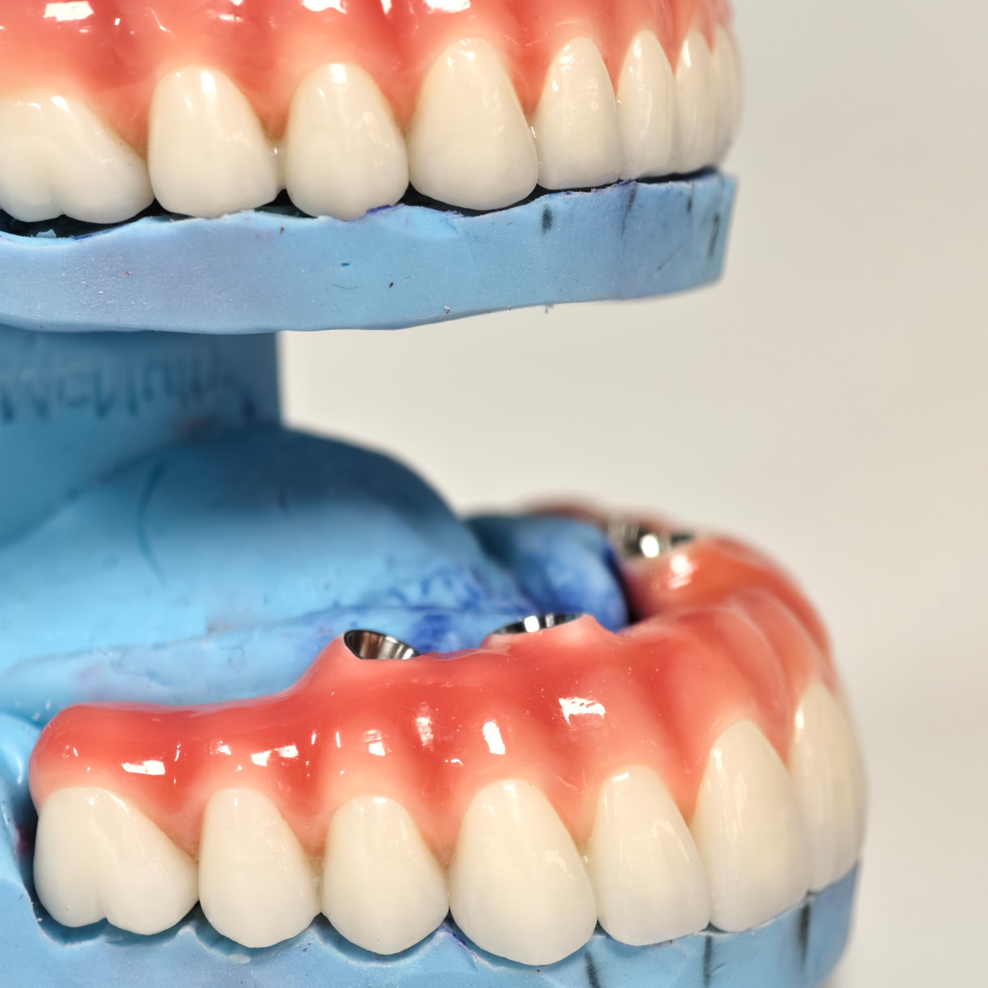 Zirconia-Enamel Hybrid Malo Bridge