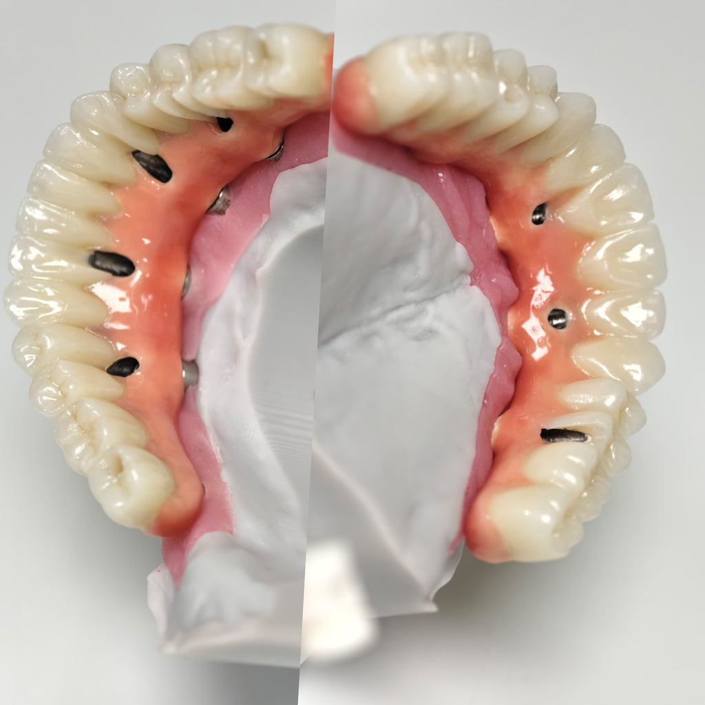 Zirconia-Enamel Hybrid Malo Bridge