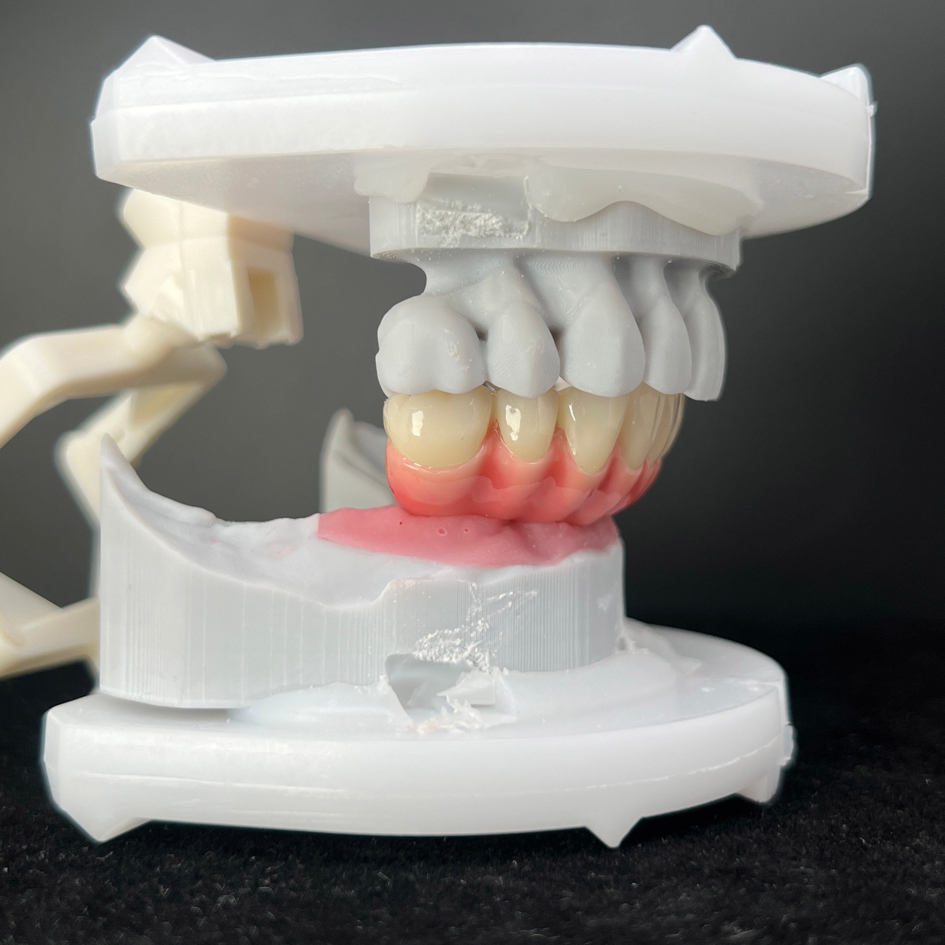 Zirconia-Enamel Hybrid Malo Bridge
